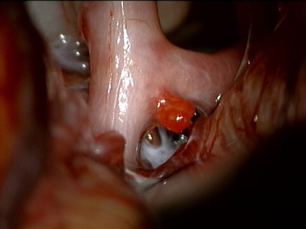 Carl Zeiss Surgical GmbH