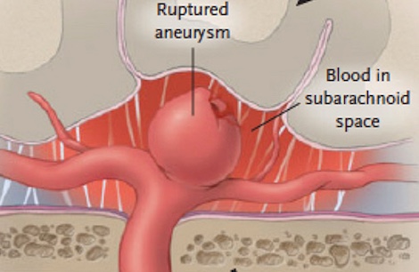 Ruptured aneurysm